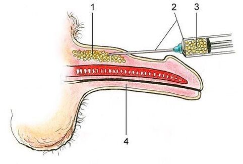 Injection of fatty tissue under the skin of the penis
