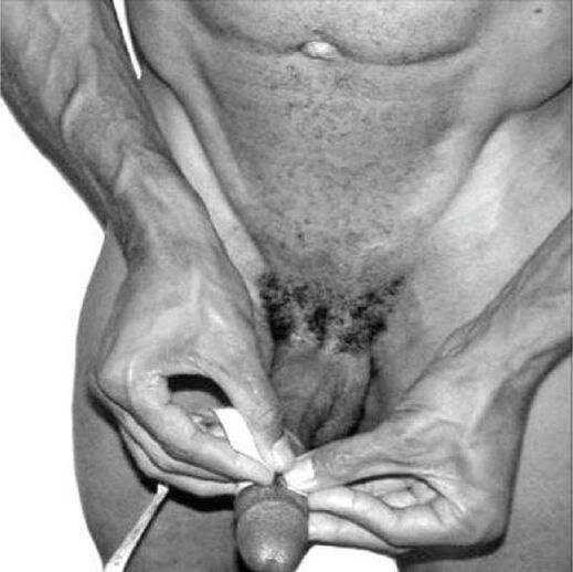 Measurement of penis before enlargement